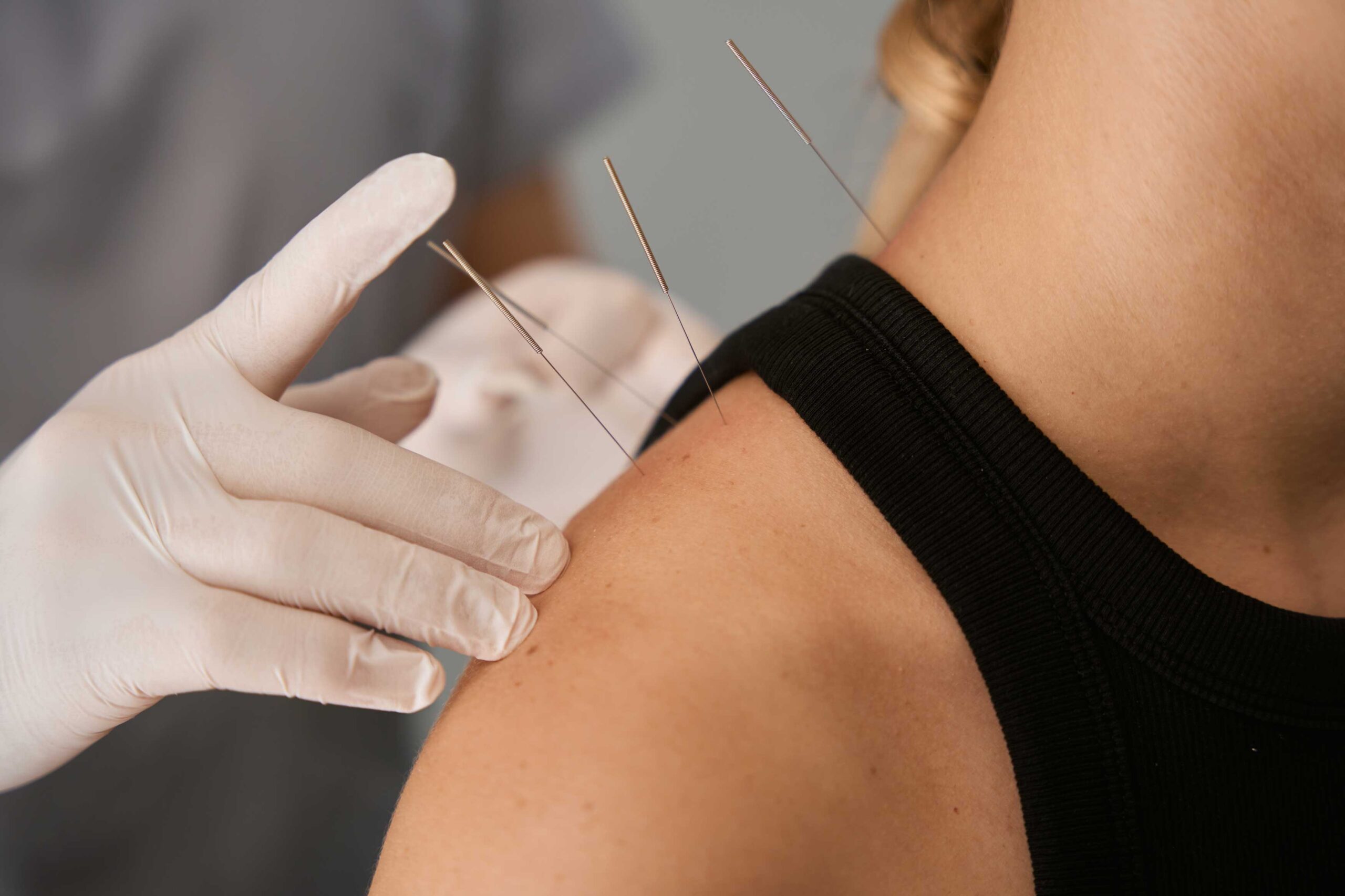 A close-up of an acupuncture treatment in progress, showing a practitioner wearing gloves carefully inserting thin needles into a patient's shoulder. The patient wears a black tank top.